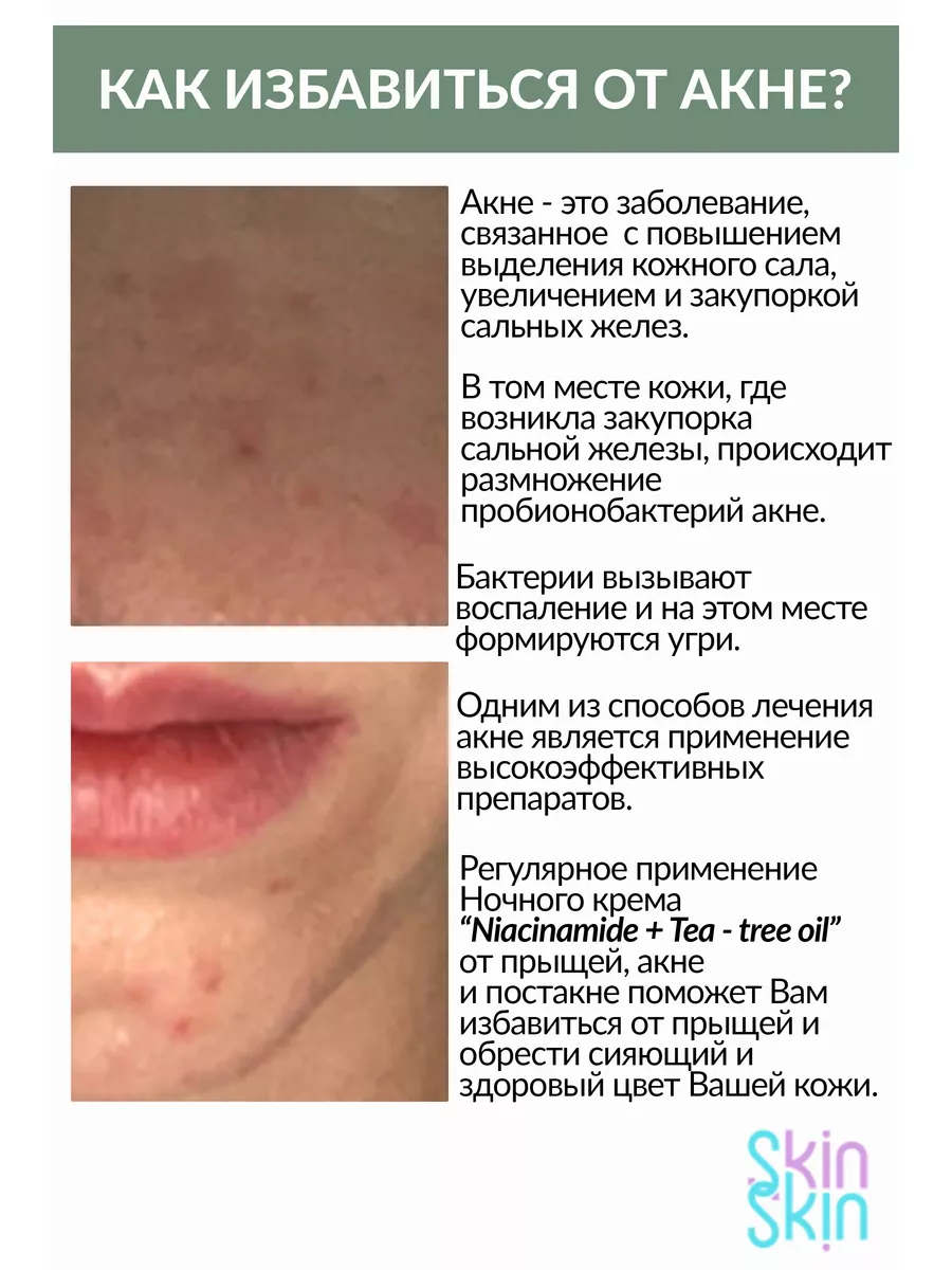 Ночная маска для проблемной кожи крем от прыщей, 50 мл SkinSkin 161326833  купить за 433 ₽ в интернет-магазине Wildberries