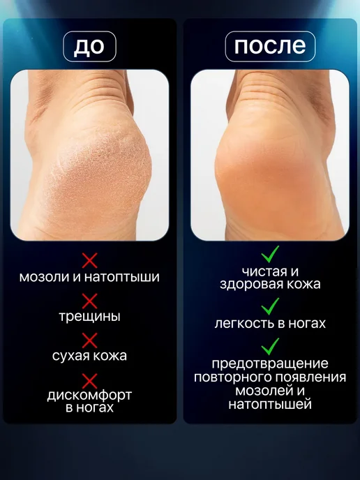 ROMMAC Педикюрный нож скребок для пяток, вариант, фото 4