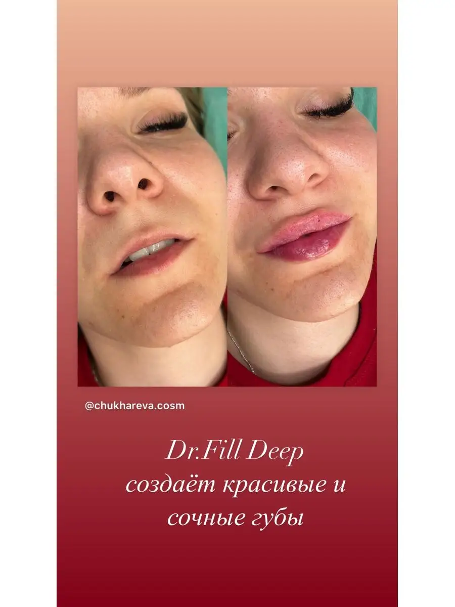 Dr.Fill Deep филлер для увеличения губ DR.FILL 164266948 купить за 2 797 ₽  в интернет-магазине Wildberries