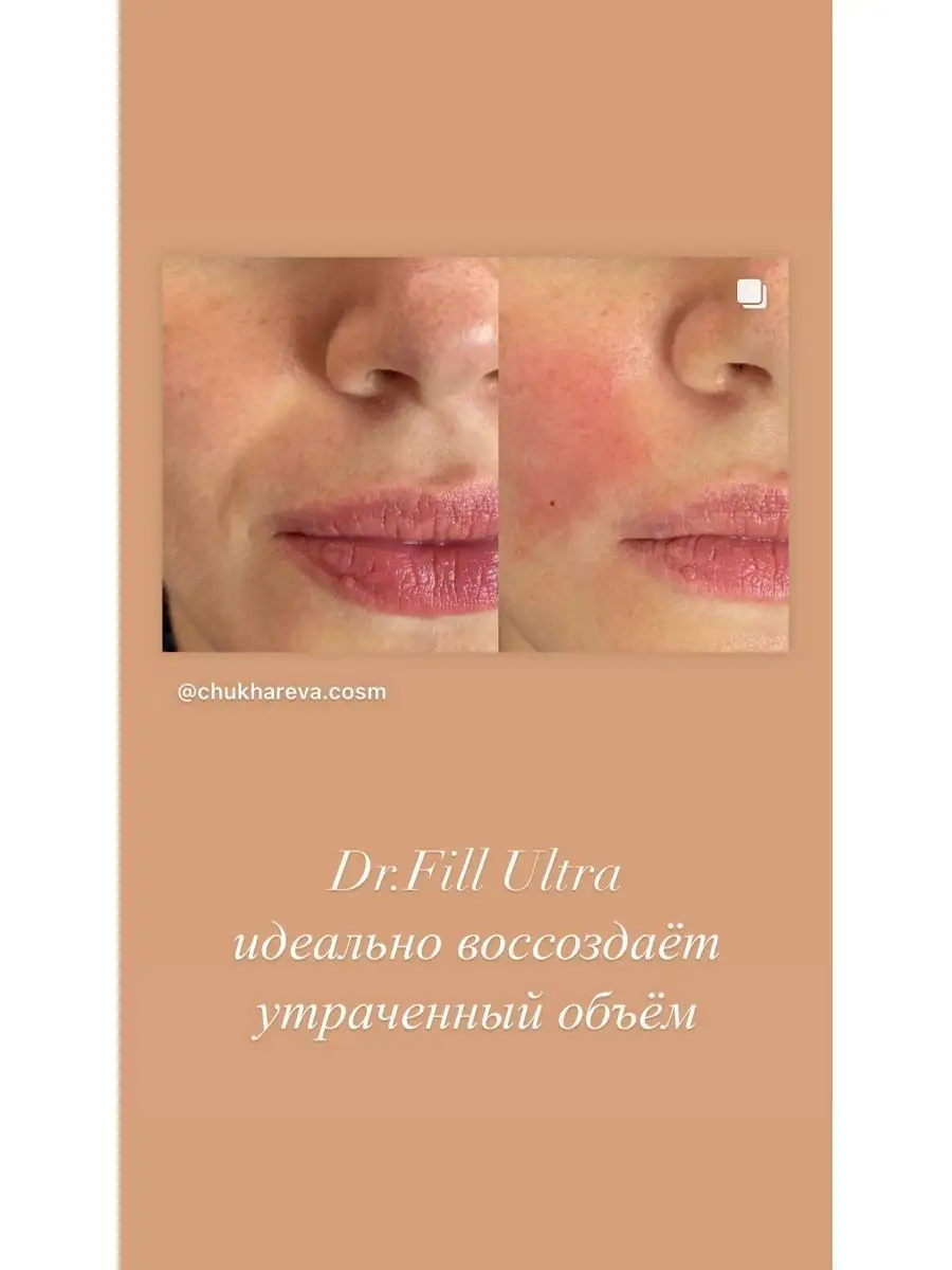 Dr.Fill Ultra филлер для увеличения губ и пластики лица DR.FILL 164270623  купить за 2 646 ₽ в интернет-магазине Wildberries